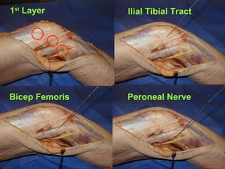 1st Layer

Ilial Tibial Tract

Bicep Femoris

Peroneal Nerve

 