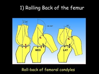 1) Rolling Back of the femur

MED

LAT

Roll-back of femoral condyles

 