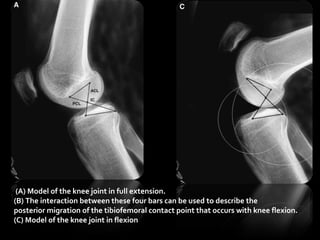 (A) Model of the knee joint in full extension.
(B) The interaction between these four bars can be used to describe the
posterior migration of the tibiofemoral contact point that occurs with knee flexion.
(C) Model of the knee joint in flexion.

 