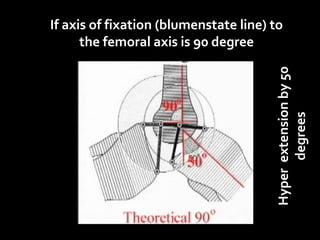 Hyper extension by 50
degrees

If axis of fixation (blumenstate line) to
the femoral axis is 90 degree

 