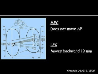 MFC
Does not move AP

LFC
Moves backward 19 mm

Freeman, JBJS-B, 2000

 