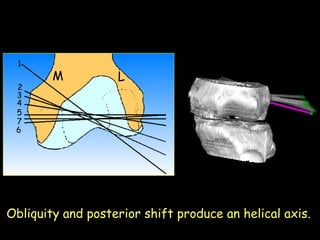 1
2
3
4
5
7
6

M

L

Obliquity and posterior shift produce an helical axis.

 