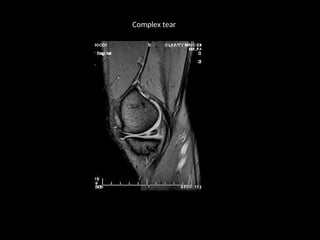 mri of the knee - acl pcl mensicus and collaterals | PPT