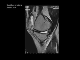 mri of the knee - acl pcl mensicus and collaterals | PPT