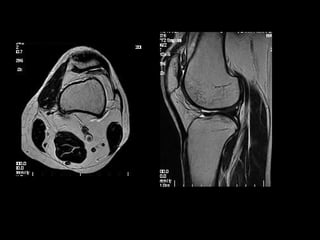 mri of the knee - acl pcl mensicus and collaterals | PPT