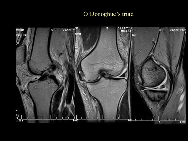 knee mri mri of knee