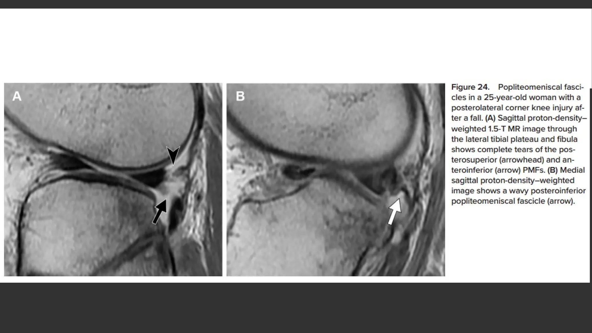 Knee MRI of meniscal injuries of knee joint.pptx