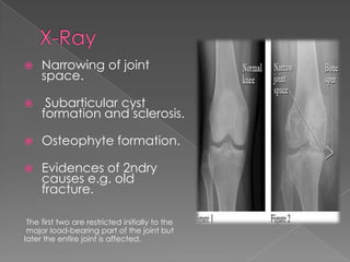  Narrowing of joint
space.
 Subarticular cyst
formation and sclerosis.
 Osteophyte formation.
 Evidences of 2ndry
causes e.g. old
fracture.
The first two are restricted initially to the
major load-bearing part of the joint but
later the entire joint is affected.
 