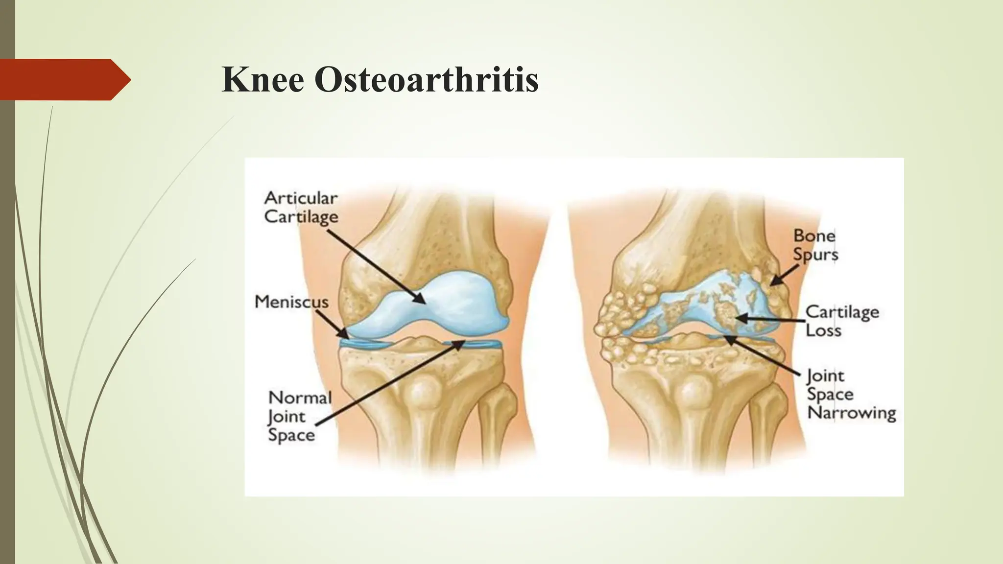 Knee Classification detection and classification of knee osteoarthritis.pptx
