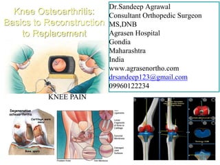 Dr.Sandeep Agrawal
Consultant Orthopedic Surgeon
MS,DNB
Agrasen Hospital
Gondia
Maharashtra
India
www.agrasenortho.com
drsandeep123@gmail.com
09960122234
Knee Osteoarthritis:
Basics to Reconstruction
to Replacement
 
