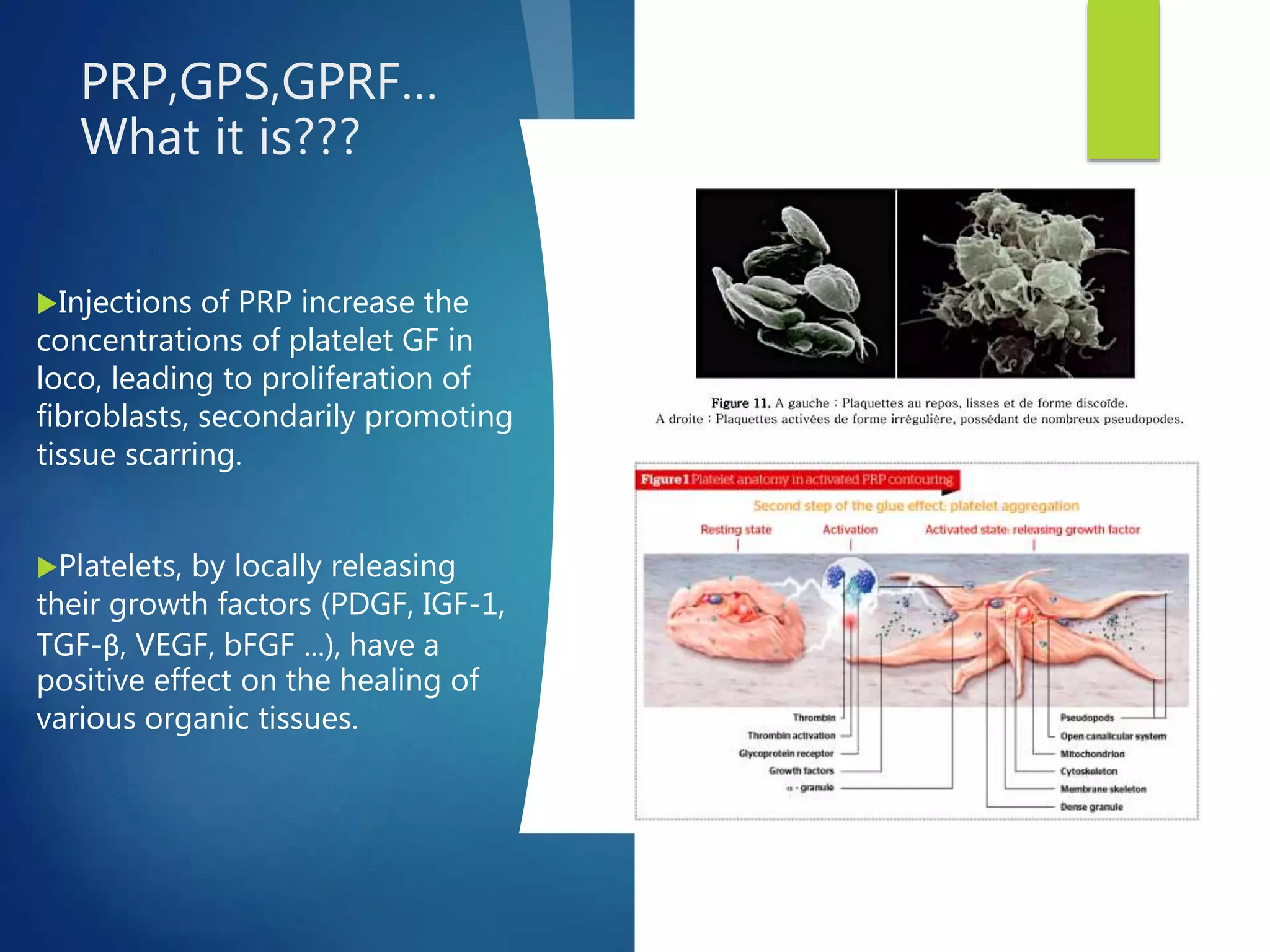 Knee osteochondritis and platelet rich plasma | PPTX