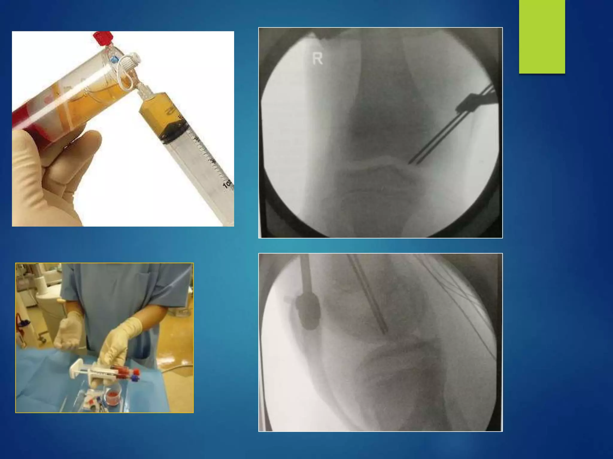 Knee osteochondritis and platelet rich plasma | PPTX