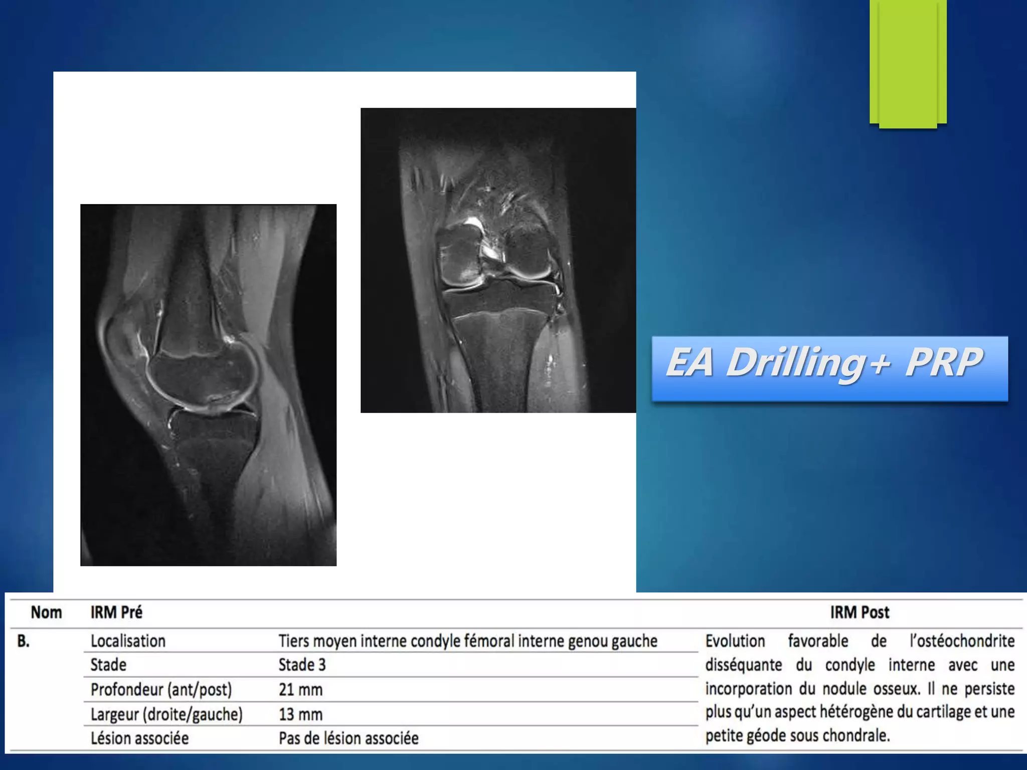 Knee osteochondritis and platelet rich plasma | PPTX