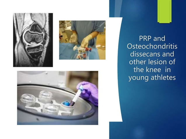Knee osteochondritis and platelet rich plasma | PPTX | Bone and Joint ...