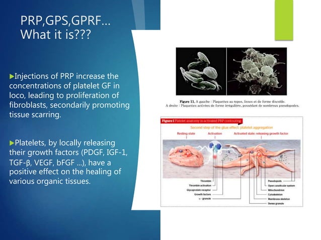 Knee osteochondritis and platelet rich plasma | PPTX | Bone and Joint ...