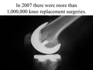 In 2007 there were more than
1,000,000 knee replacement surgeries.
 
