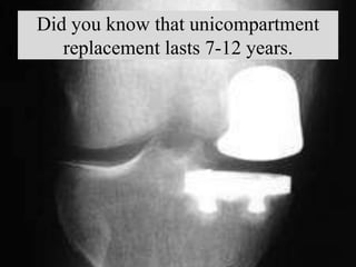 Did you know that unicompartment
replacement lasts 7-12 years.
 