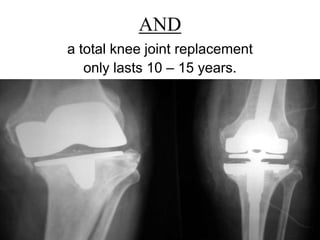 AND
a total knee joint replacement
only lasts 10 – 15 years.
 