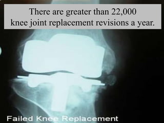 There are greater than 22,000
knee joint replacement revisions a year.
 