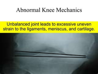 Abnormal Knee Mechanics
Unbalanced joint leads to excessive uneven
strain to the ligaments, meniscus, and
cartilage.
 