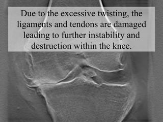Due to the excessive twisting, the
ligaments and tendons are damaged
leading to further instability and
destruction within...