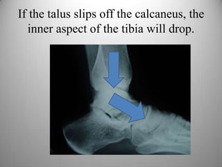 If the talus slips off the calcaneus,
this drops the inner aspect of the tibia.
 