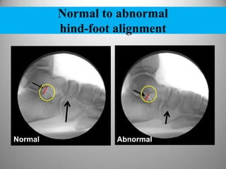 Normal to abnormal
hind-foot alignment
Normal Abnormal
 