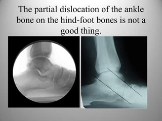 The partial dislocation of the ankle
bone on the hind-foot bones is not a
good thing.
 