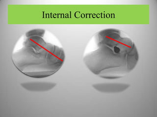 Internal Correction
 