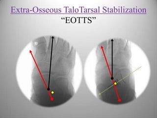 Extra-Osseous TaloTarsal Stabilization
“EOTTS”
 