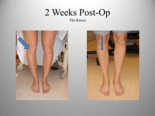 2 Weeks Post-Op
The Knees
 