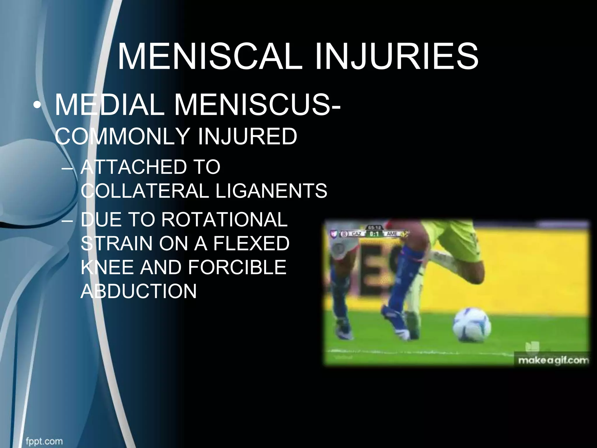 Maniscal Injury Meniscal Injuries | PPTX