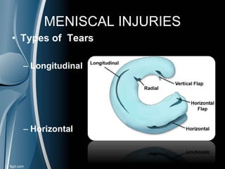 MENISCAL INJURIES
• Types of Tears
– Longitudinal
– Horizontal
 