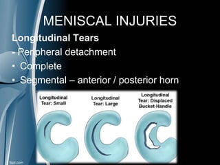 MENISCAL INJURIES
Longitudinal Tears
- Peripheral detachment
• Complete
• Segmental – anterior / posterior horn
 