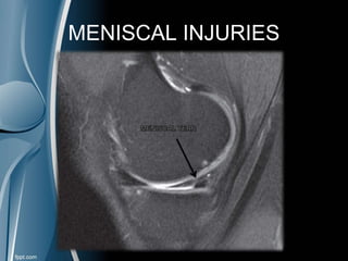 MENISCAL INJURIES
 