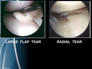 LARGE FLAP TEAR RADIAL TEAR
 