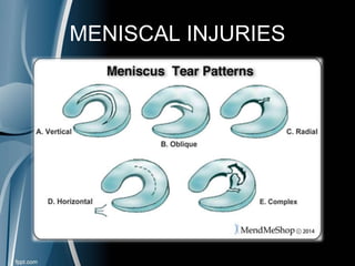 MENISCAL INJURIES
 