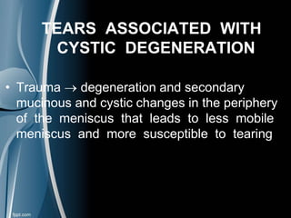 TEARS ASSOCIATED WITH
CYSTIC DEGENERATION
• Trauma  degeneration and secondary
mucinous and cystic changes in the periphery
of the meniscus that leads to less mobile
meniscus and more susceptible to tearing
 