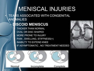 MENISCAL INJURIES
• TEARS ASSOCIATED WITH CONGENITAL
ANOMALIES
– DISCOID MENISCUS
• THICKER THAN NORMAL
• OVAL OR DISC SHAPED
• MORE PRONE TO INJURY
• PAIN , SWELLING, STIFFNESS(+)
• INABILTY TO EXTEND KNEE
• IF ASYMPTOMATIC , NO TREATMENT NEEDED
 
