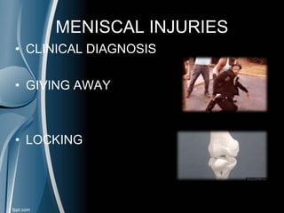 MENISCAL INJURIES
• CLINICAL DIAGNOSIS
• GIVING AWAY
• LOCKING
 