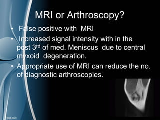 MRI or Arthroscopy?
• False positive with MRI
• Increased signal intensity with in the
post 3rd of med. Meniscus due to central
myxoid degeneration.
• Appropriate use of MRI can reduce the no.
of diagnostic arthroscopies.
 