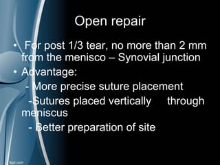 Open repair
• For post 1/3 tear, no more than 2 mm
from the menisco – Synovial junction
• Advantage:
- More precise suture placement
-Sutures placed vertically through
meniscus
- Better preparation of site
 