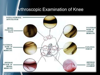 Arthroscopic Examination of Knee
 