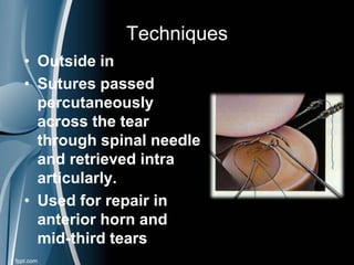 Techniques
• Outside in
• Sutures passed
percutaneously
across the tear
through spinal needle
and retrieved intra
articularly.
• Used for repair in
anterior horn and
mid-third tears
 