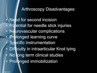 Arthroscopy Disadvantages:
• Need for second incision
• Potential for needle stick injuries
• Neurovascular complications
• Prolonged learning curve
• Specific instrumentation
• Difficulty in intraarticular Knot tying
• No long term clinical studies
• Prolonged immobilization
 