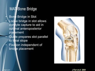 • Bone Bridge in Slot
• Loose bridge in slot allows
condyle capture to aid in
optimal anteroposterior
placement
• Guide prepares slot parallel
to tibial slope
• Fixation independent of
bridge placement
J Farr et al 2004
MAT-Bone Bridge
 