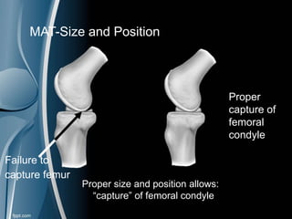 Failure to
capture femur
Proper
capture of
femoral
condyle
Proper size and position allows:
“capture” of femoral condyle
MAT-Size and Position
 