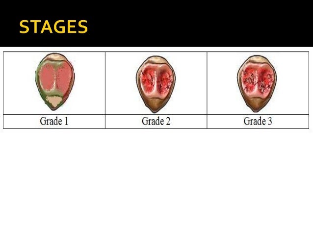 Knee Pain In Young Adults Chondromalacia Patella Knee Pain In Young Adults Chondromalacia Patella
