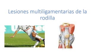 Lesiones multiligamentarias de la
rodilla
 