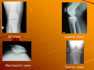 AP View Lateral View
Merchant’s view
Tunnel View
 